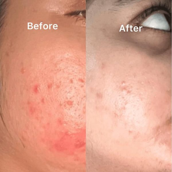 Nirvana Botanics Vitamin C + E Serum – 15ml | Anti Acne & Glowing Serum Vitamin C + E